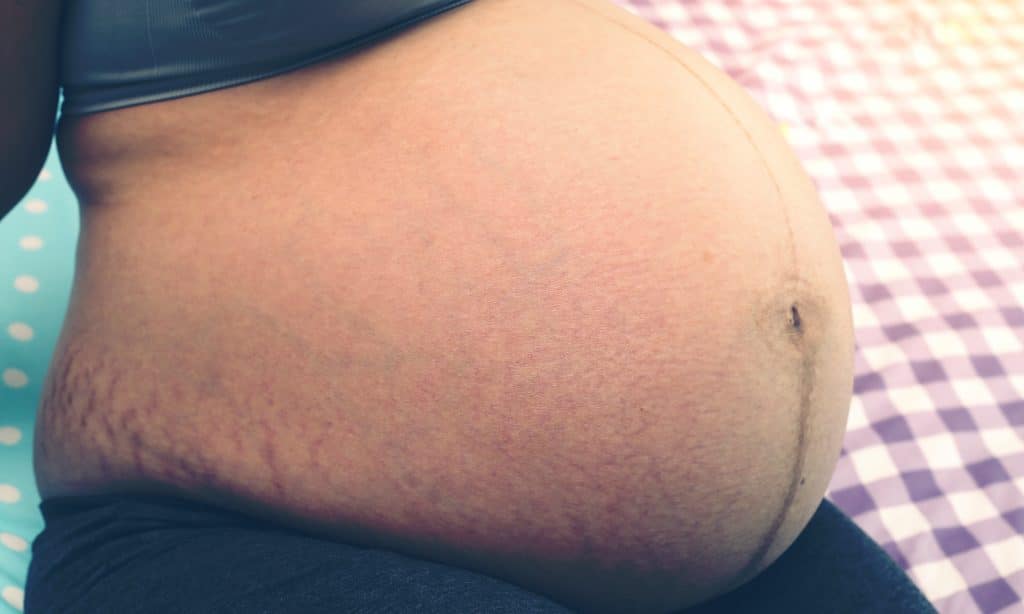 pregnant woman belly with marks